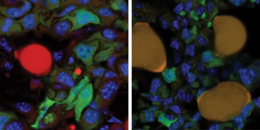 Grün markierte Krebszellen und eine rot markierte Fettzelle an der Oberfläche eines Tumors (links). Nach der Therapie (rechts) haben sich drei ehemalige Krebszellen in Fettzellen umgewandelt. Die kombinierte Markierung mit Grün und Rot lässt sie dunkelgelb erscheinen. (Bild: Universität Basel, Departement Biomedizin)